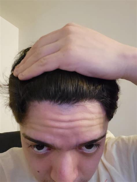 reddit receding hairline|receding hairline haircut reddit.